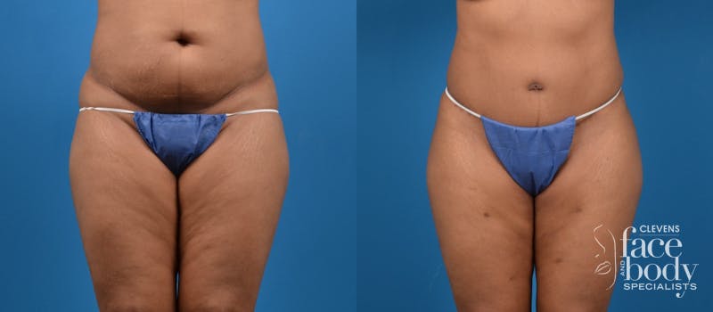 Hidden Tummy Tuck Before & After Gallery - Patient 533958 - Image 1