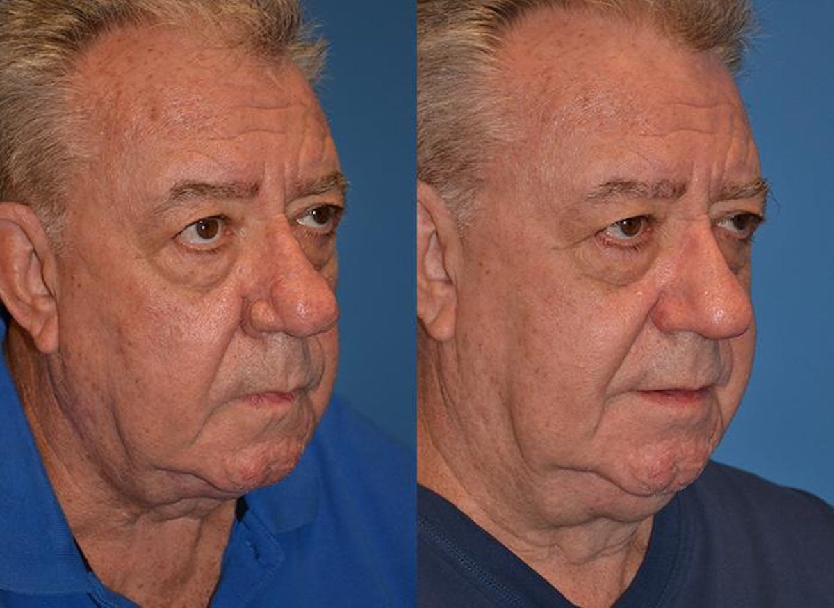 Skin Resurfacing Before & After Gallery - Patient 122406628 - Image 2