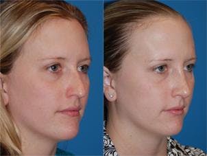 Rhinoplasty Before & After Gallery - Patient 122406627 - Image 2