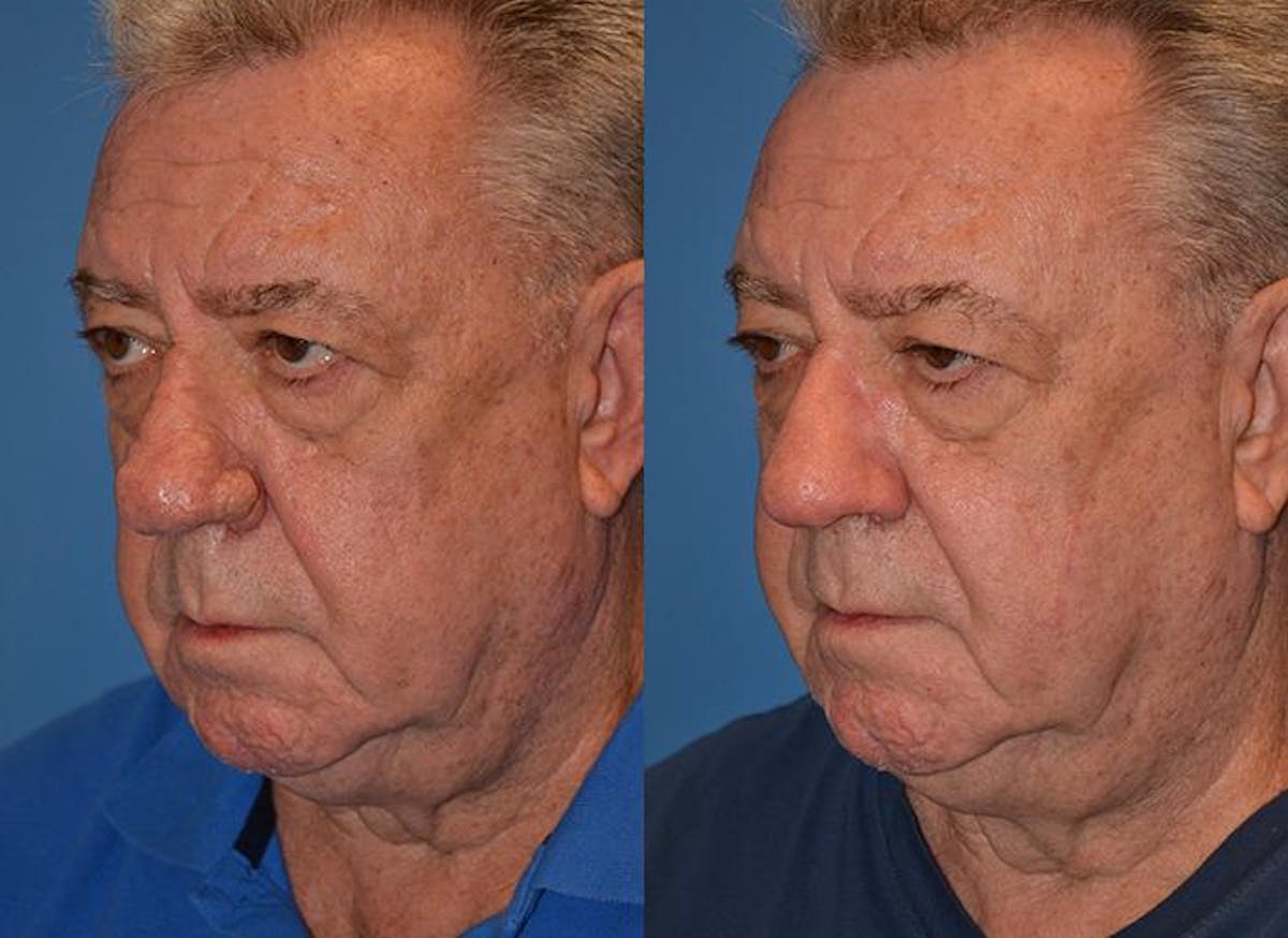 Skin Resurfacing Before & After Gallery - Patient 122406628 - Image 3
