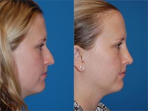 Rhinoplasty Before & After Gallery - Patient 122406627 - Image 3