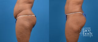 Hidden Tummy Tuck Before & After Gallery - Patient 533958 - Image 2