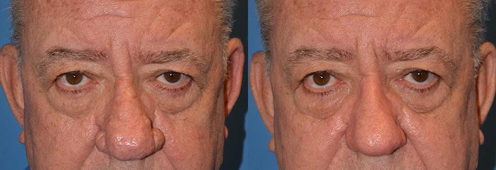 Skin Resurfacing Before & After Gallery - Patient 122406628 - Image 4