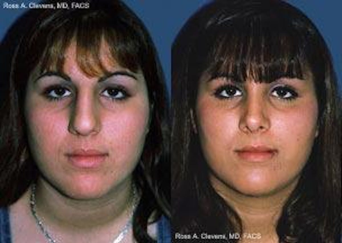 Rhinoplasty Before & After Gallery - Patient 122406631 - Image 1