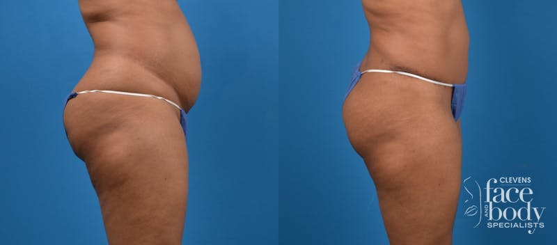 Hidden Tummy Tuck Before & After Gallery - Patient 533958 - Image 3