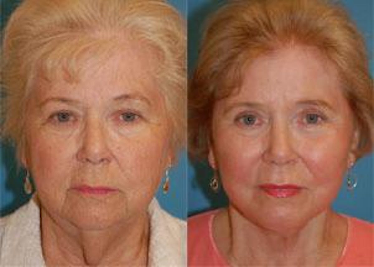 Skin Resurfacing Before & After Gallery - Patient 122406630 - Image 1