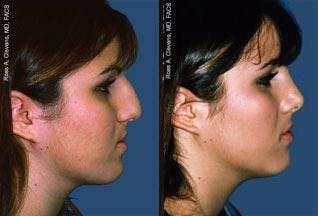 Rhinoplasty Before & After Gallery - Patient 122406631 - Image 2