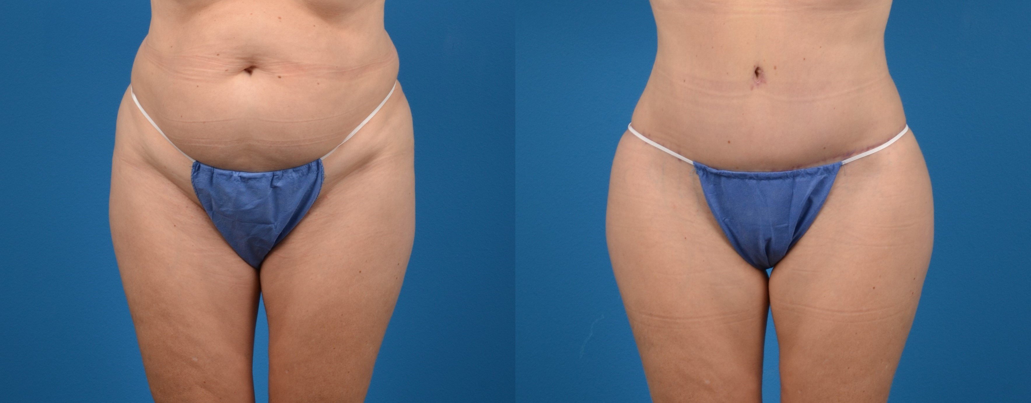 Hidden Tummy Tuck Before & After Gallery - Patient 380771 - Image 1