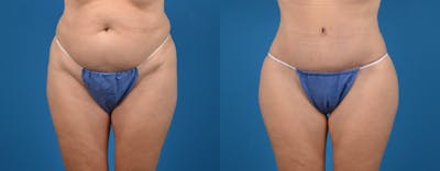 Tummy Tuck Before & After Gallery - Patient 230928 - Image 1