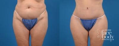 Hidden Tummy Tuck Before & After Gallery - Patient 380771 - Image 1