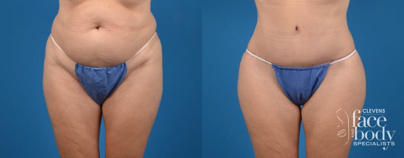 Hidden Tummy Tuck Before & After Gallery - Patient 380771 - Image 1