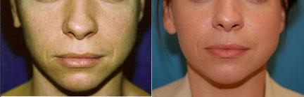 Skin Resurfacing Before & After Gallery - Patient 122406632 - Image 1