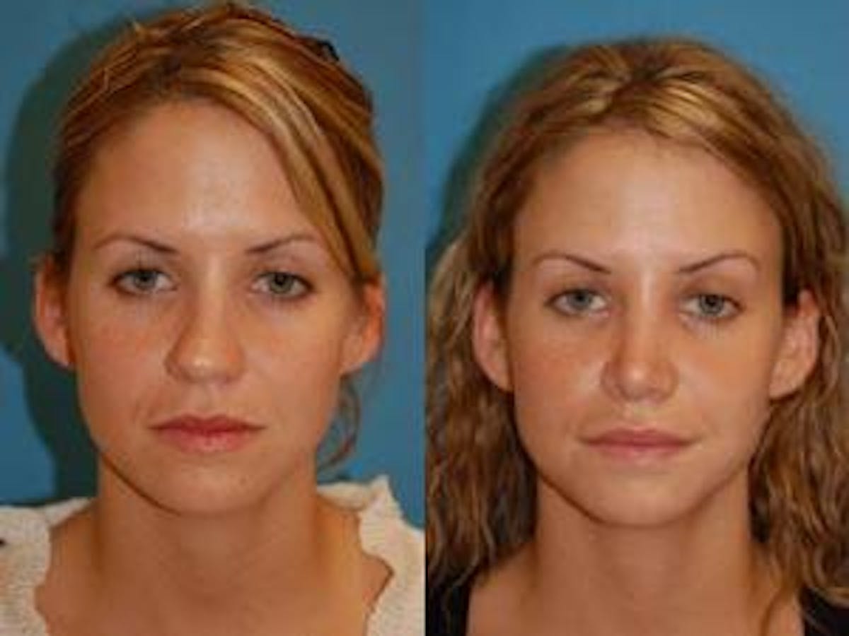 Rhinoplasty Before & After Gallery - Patient 122406634 - Image 1