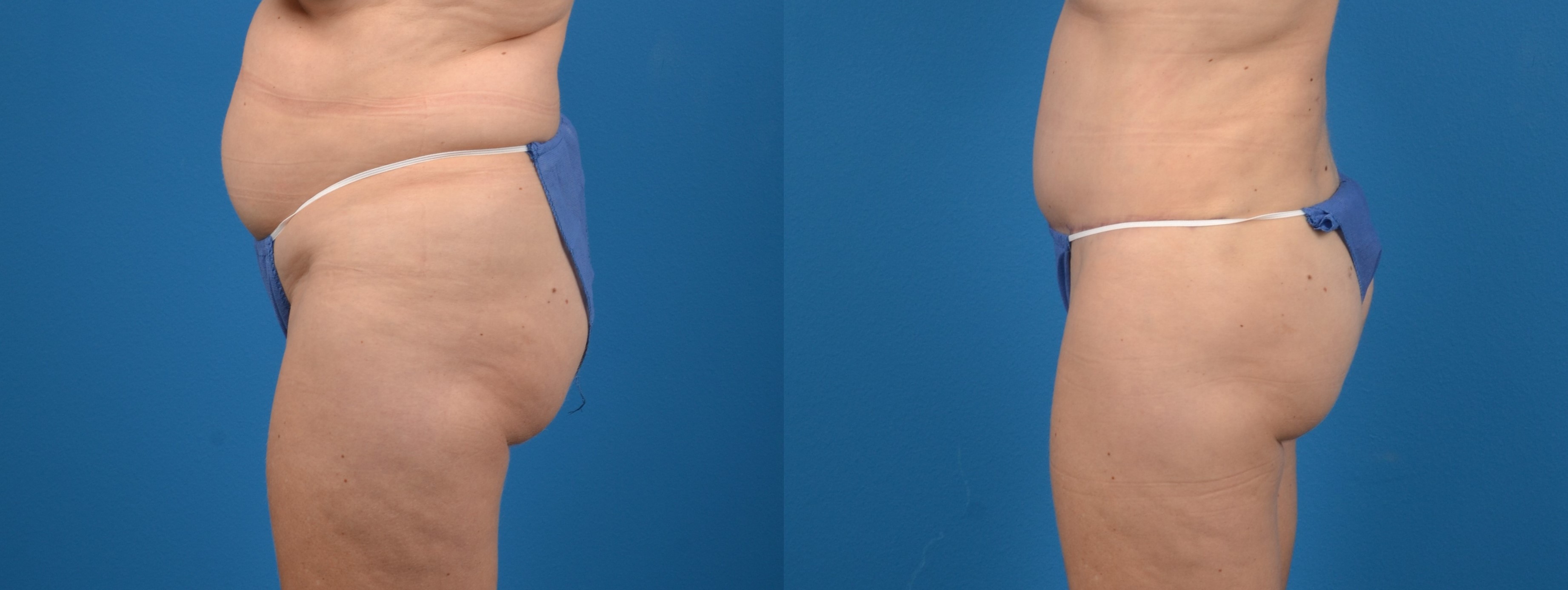 Hidden Tummy Tuck Before & After Gallery - Patient 380771 - Image 2