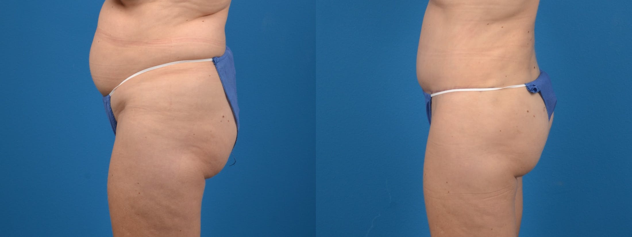 Tummy Tuck Before & After Gallery - Patient 122406637 - Image 2