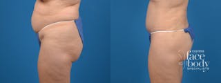 Hidden Tummy Tuck Before & After Gallery - Patient 380771 - Image 2