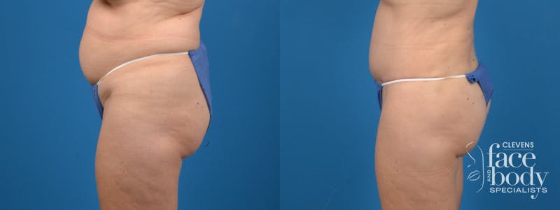 Hidden Tummy Tuck Before & After Gallery - Patient 380771 - Image 2