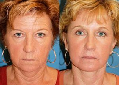 Skin Resurfacing Before & After Gallery - Patient 122406633 - Image 1