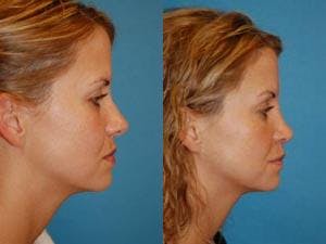 Rhinoplasty Before & After Gallery - Patient 122406634 - Image 2