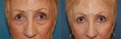 Skin Resurfacing Before & After Gallery - Patient 122406635 - Image 1