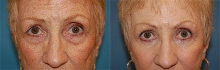 Skin Resurfacing Before & After Gallery - Patient 122406635 - Image 1
