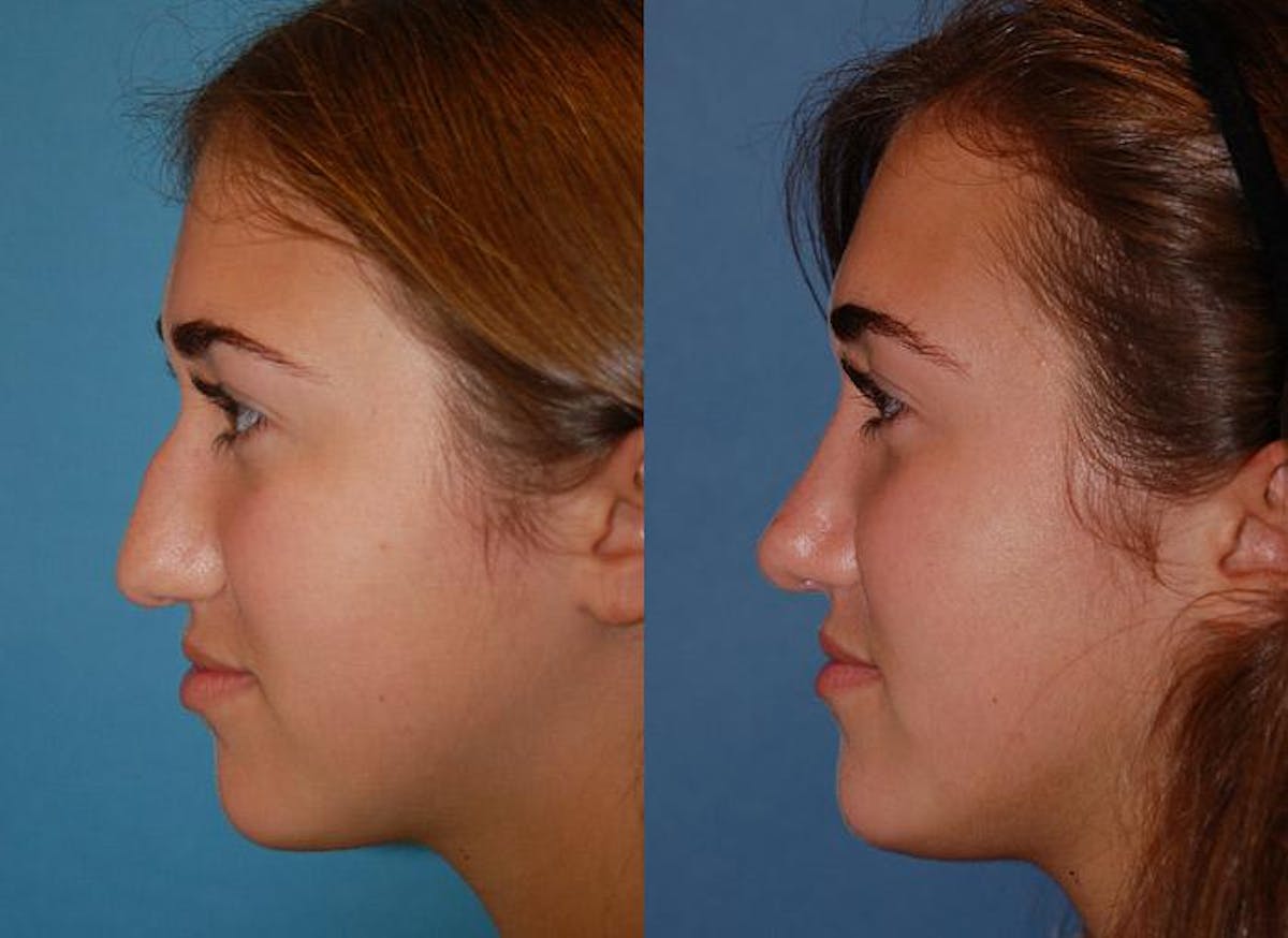 Rhinoplasty Before & After Gallery - Patient 122406636 - Image 1