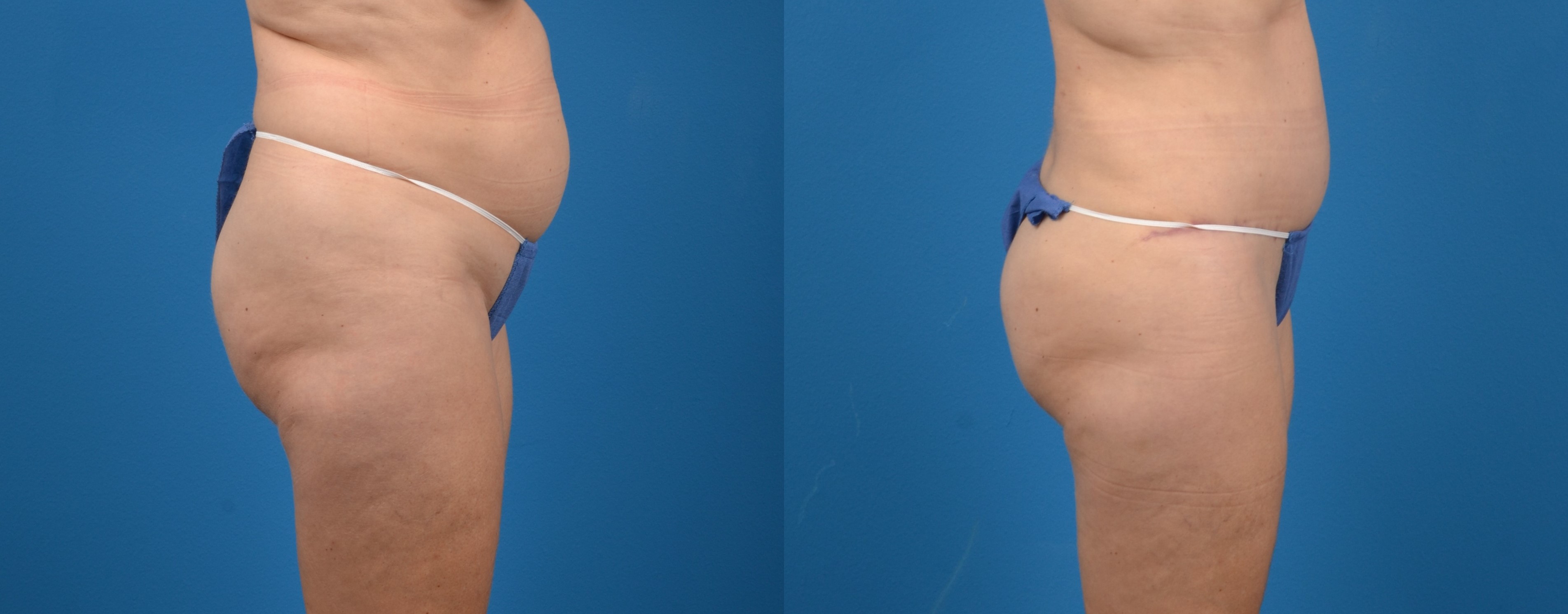 Hidden Tummy Tuck Before & After Gallery - Patient 380771 - Image 3