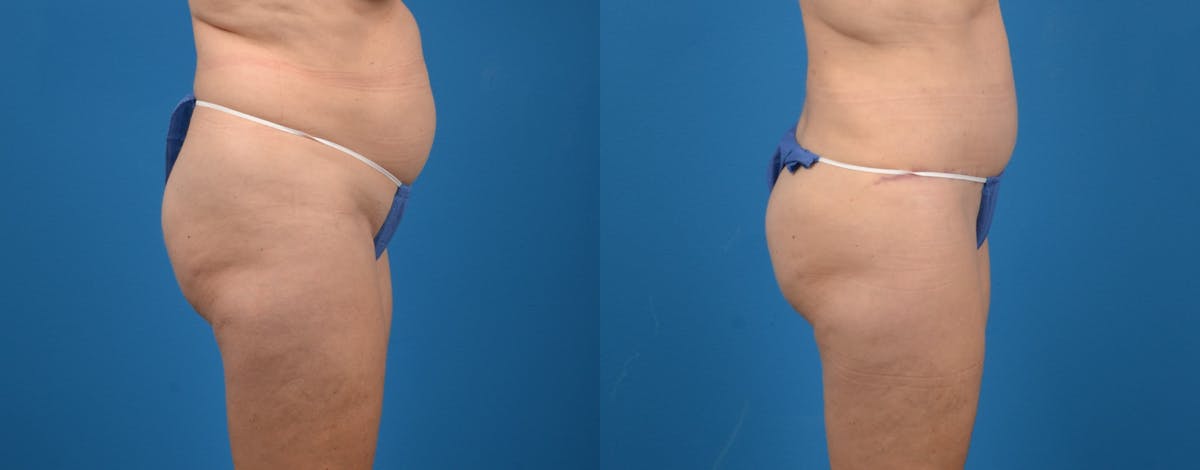 Tummy Tuck Before & After Gallery - Patient 122406637 - Image 3