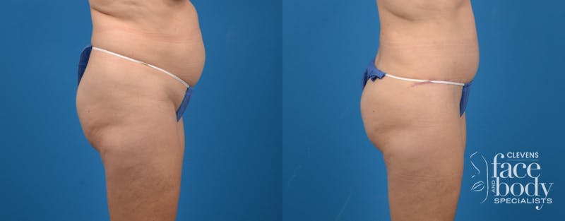 Hidden Tummy Tuck Before & After Gallery - Patient 380771 - Image 3