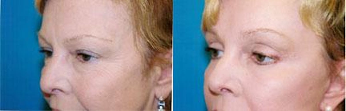 Skin Resurfacing Before & After Gallery - Patient 122406638 - Image 1