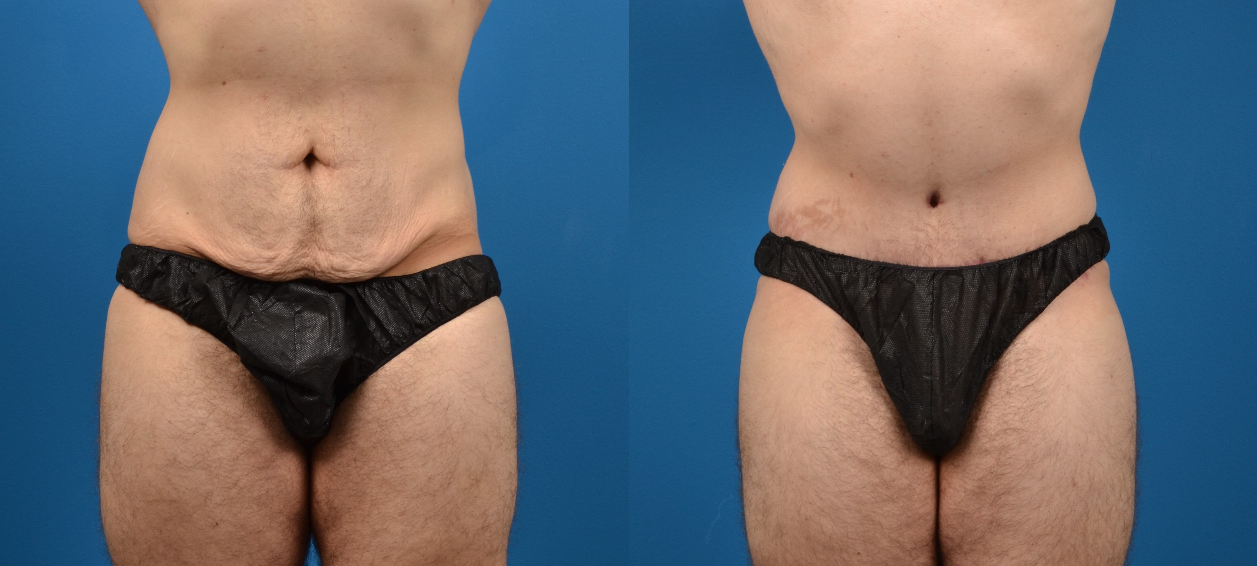 Hidden Tummy Tuck Before & After Gallery - Patient 373042 - Image 1