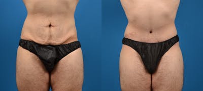 Hidden Tummy Tuck Before & After Gallery - Patient 373042 - Image 1