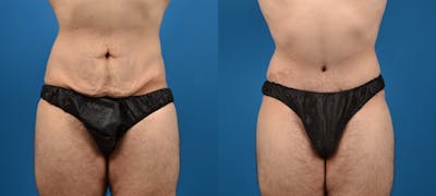 Tummy Tuck Before & After Gallery - Patient 207744 - Image 1