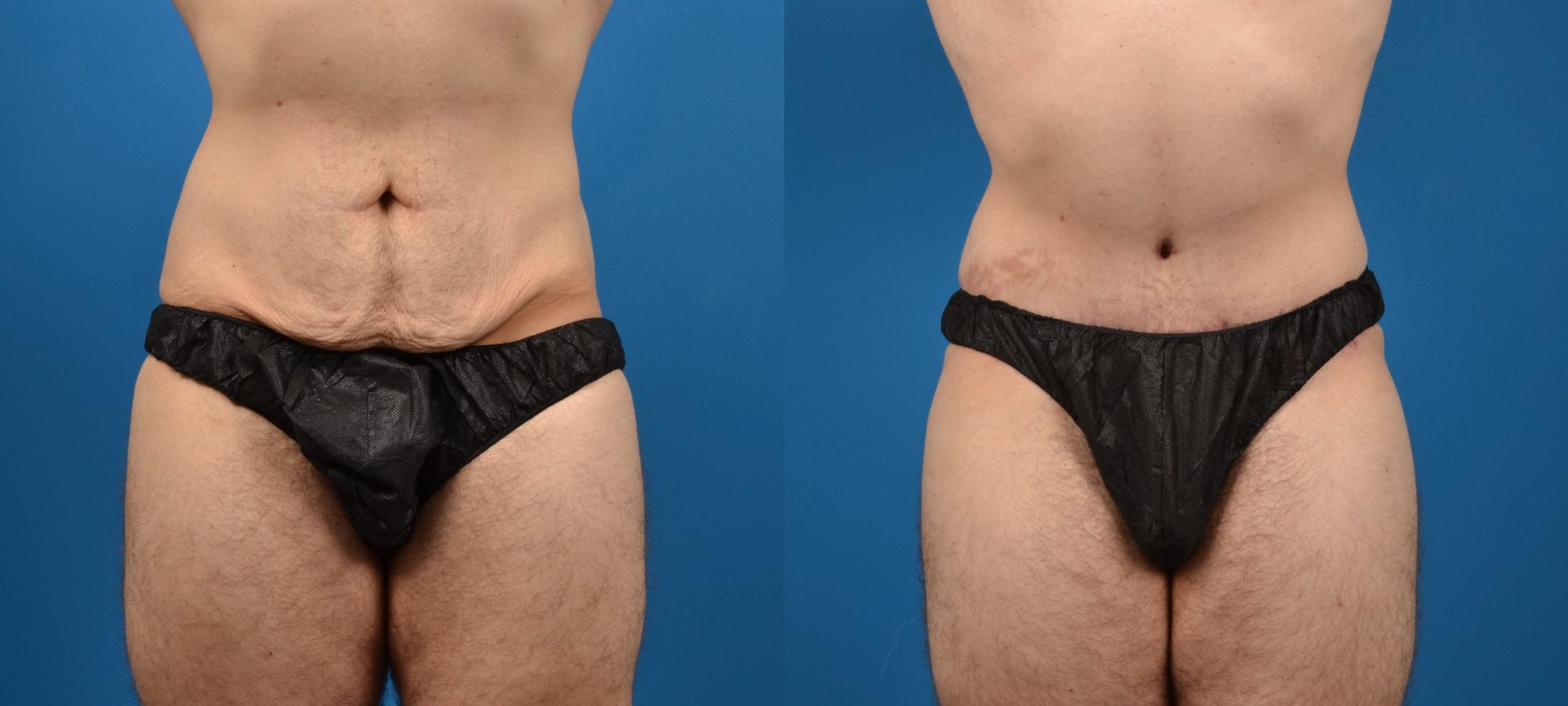 Tummy Tuck Before & After Gallery - Patient 122406646 - Image 1