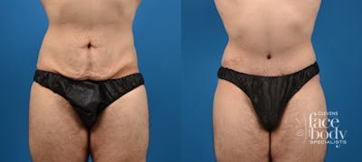 Hidden Tummy Tuck Before & After Gallery - Patient 373042 - Image 1