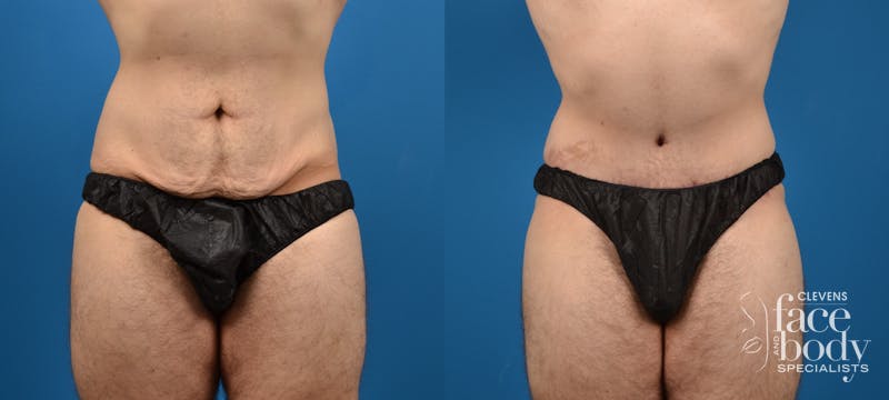 Hidden Tummy Tuck Before & After Gallery - Patient 373042 - Image 1