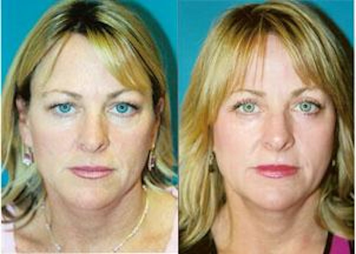 Skin Resurfacing Before & After Gallery - Patient 122406639 - Image 1