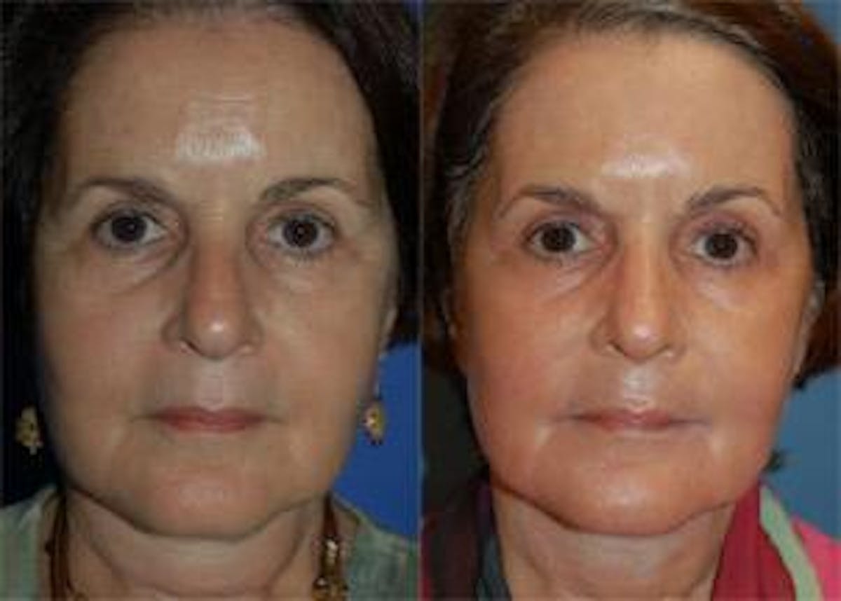 Skin Resurfacing Before & After Gallery - Patient 122406641 - Image 1