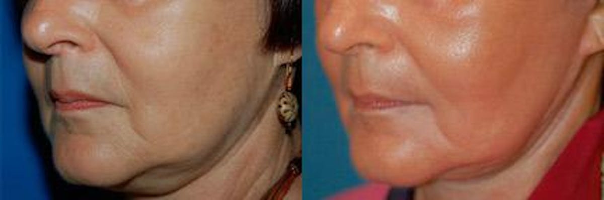Skin Resurfacing Before & After Gallery - Patient 122406641 - Image 2