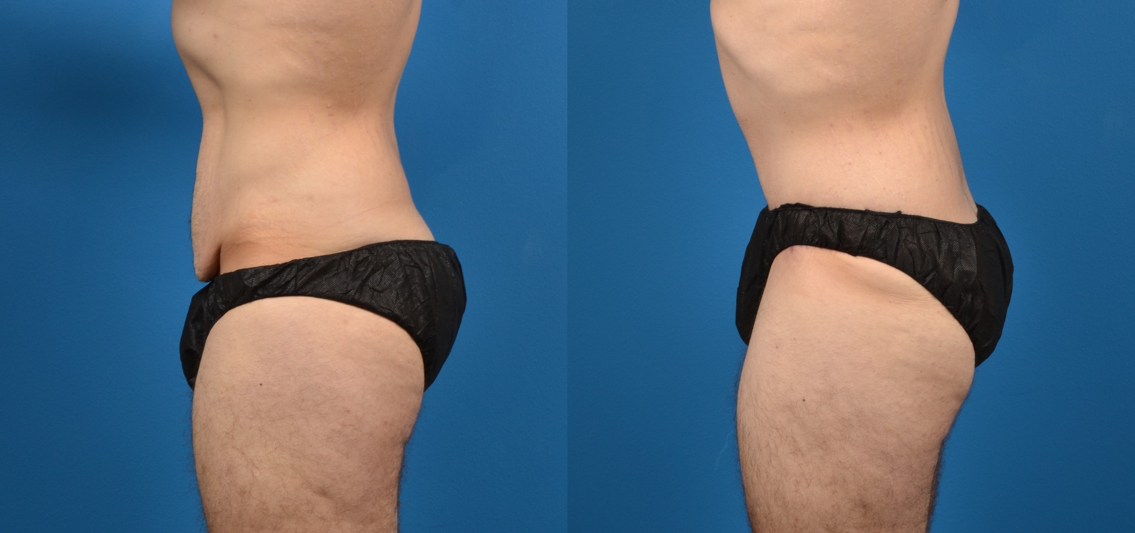 Hidden Tummy Tuck Before & After Gallery - Patient 373042 - Image 2
