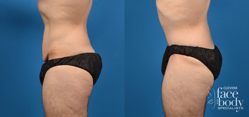 Hidden Tummy Tuck Before & After Gallery - Patient 373042 - Image 2