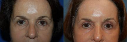 Skin Resurfacing Before & After Gallery - Patient 122406641 - Image 3
