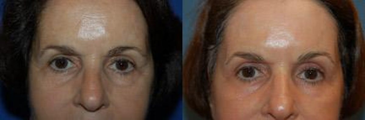 Skin Resurfacing Before & After Gallery - Patient 122406641 - Image 3