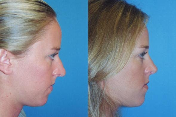 Rhinoplasty Before & After Gallery - Patient 122406642 - Image 1