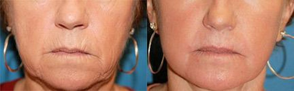 Skin Resurfacing Before & After Gallery - Patient 122406643 - Image 1