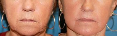 Skin Resurfacing Before & After Gallery - Patient 122406643 - Image 1