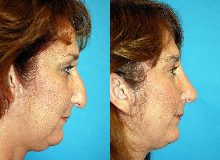 Rhinoplasty Before & After Gallery - Patient 122406644 - Image 1