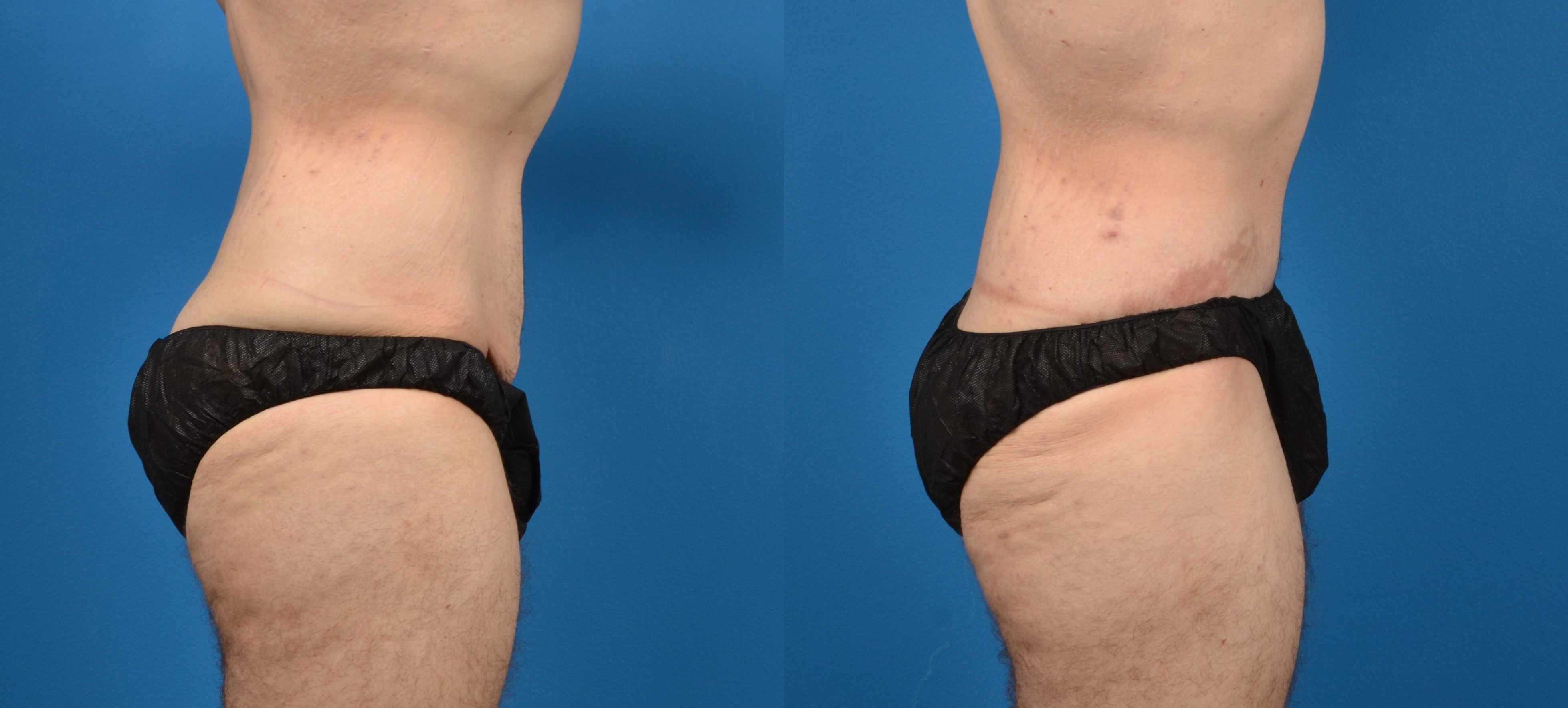 Hidden Tummy Tuck Before & After Gallery - Patient 373042 - Image 3