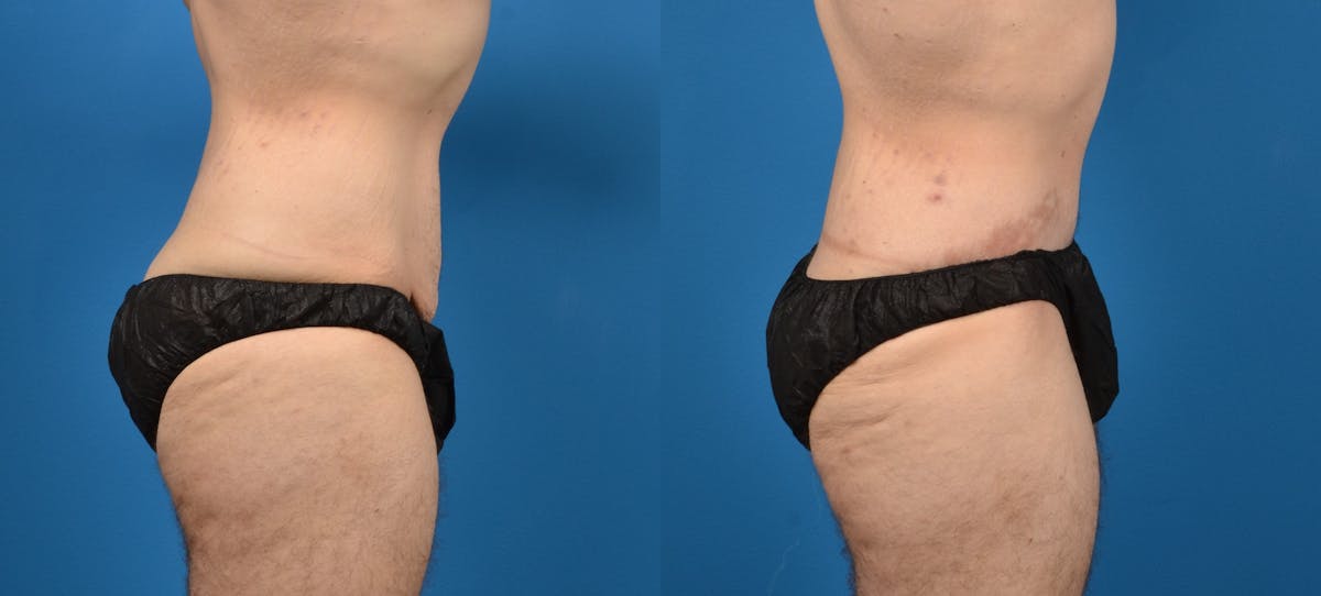 Tummy Tuck Before & After Gallery - Patient 207744 - Image 3