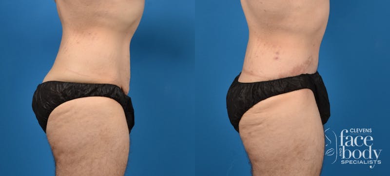 Hidden Tummy Tuck Before & After Gallery - Patient 373042 - Image 3